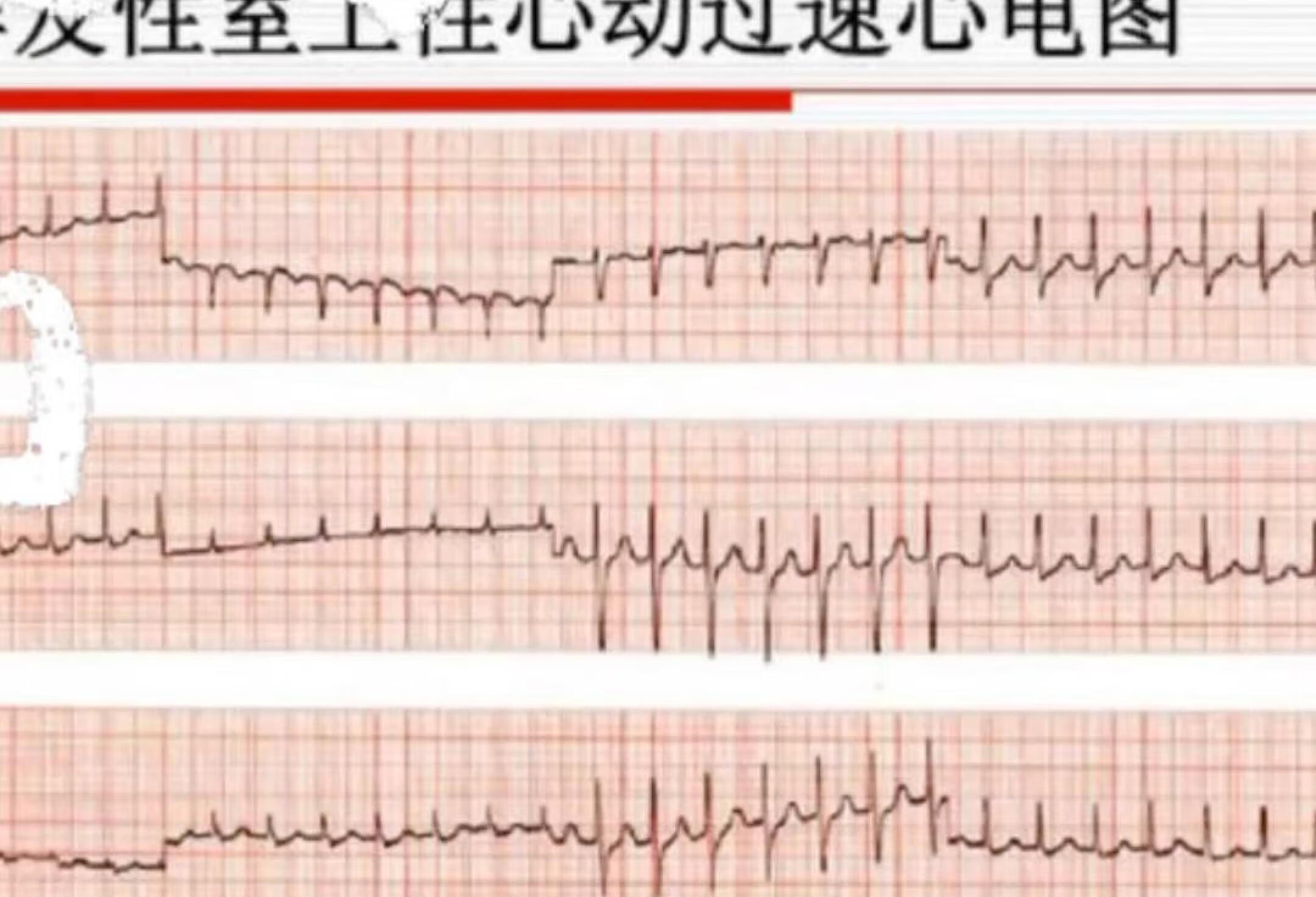 最常考的一种心律失常