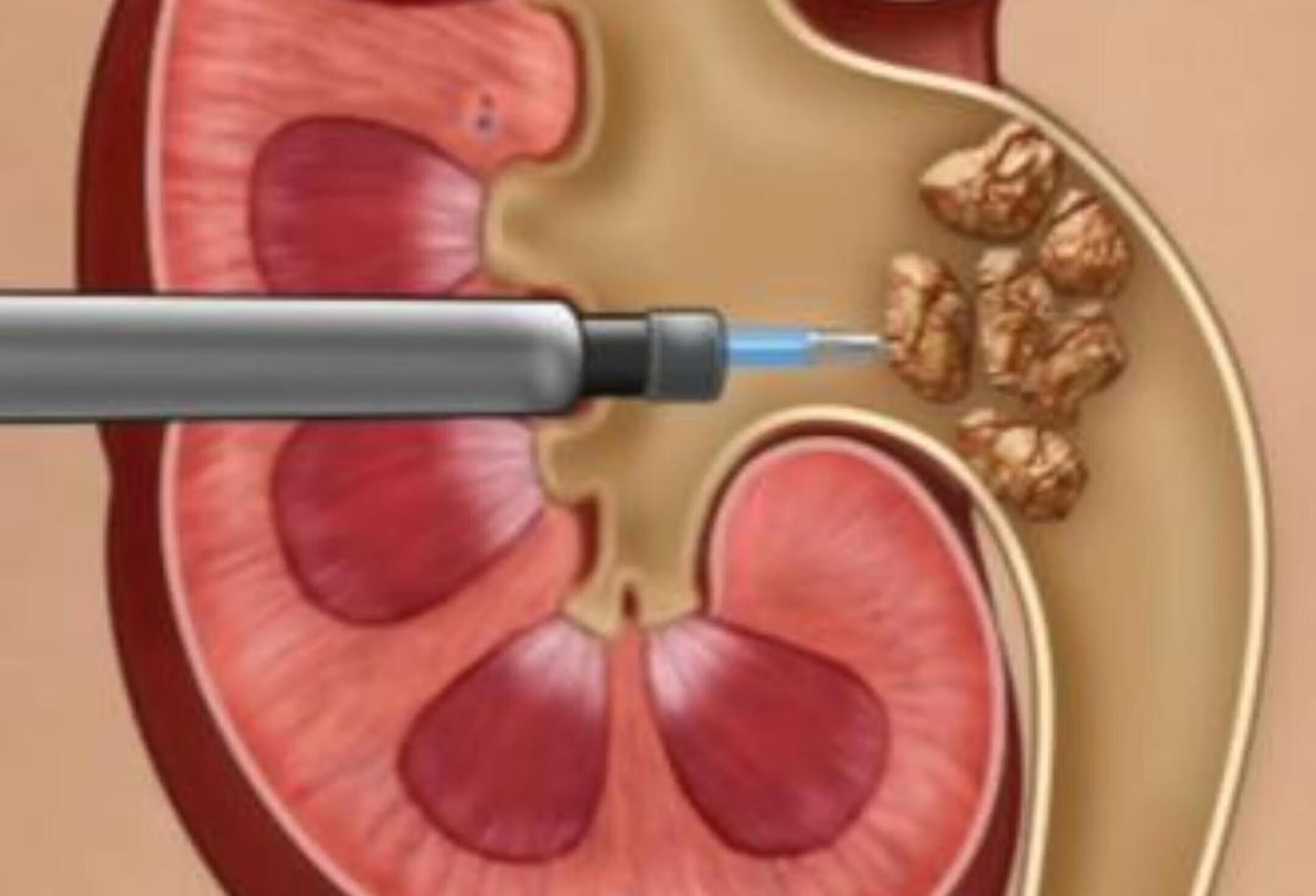 医生揭秘肾结石治疗全过程