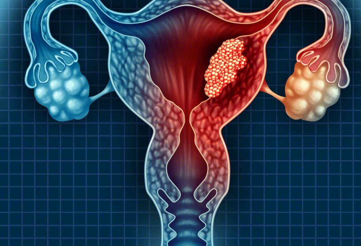 感染HPV一定得宫颈癌吗？