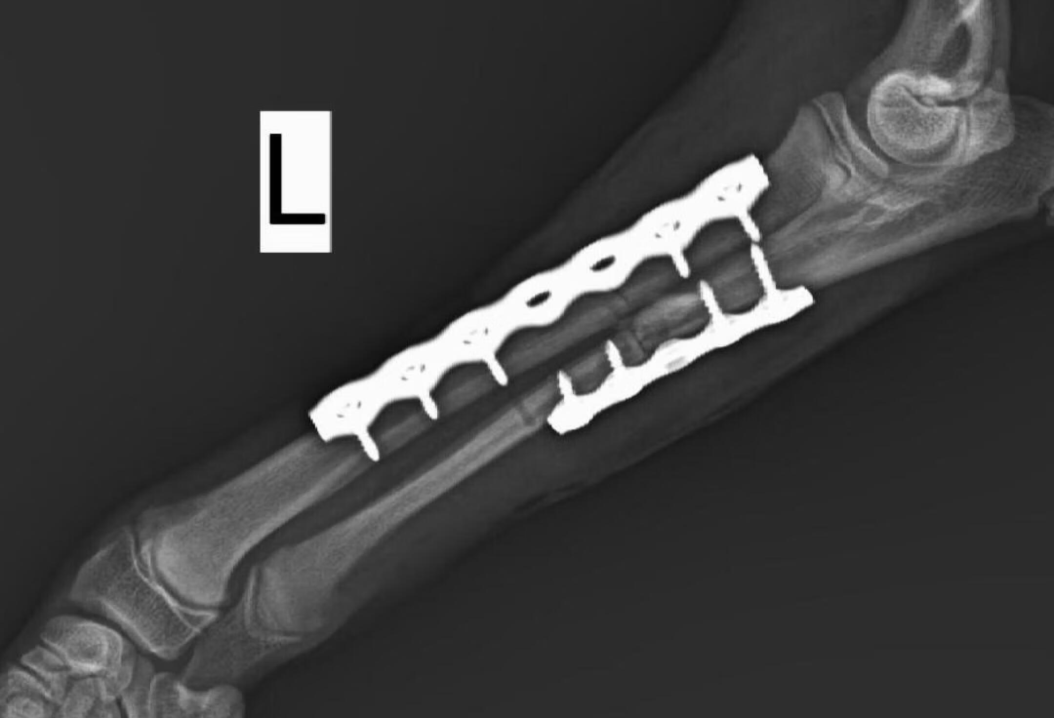 犬桡尺骨近端骨折内固定
