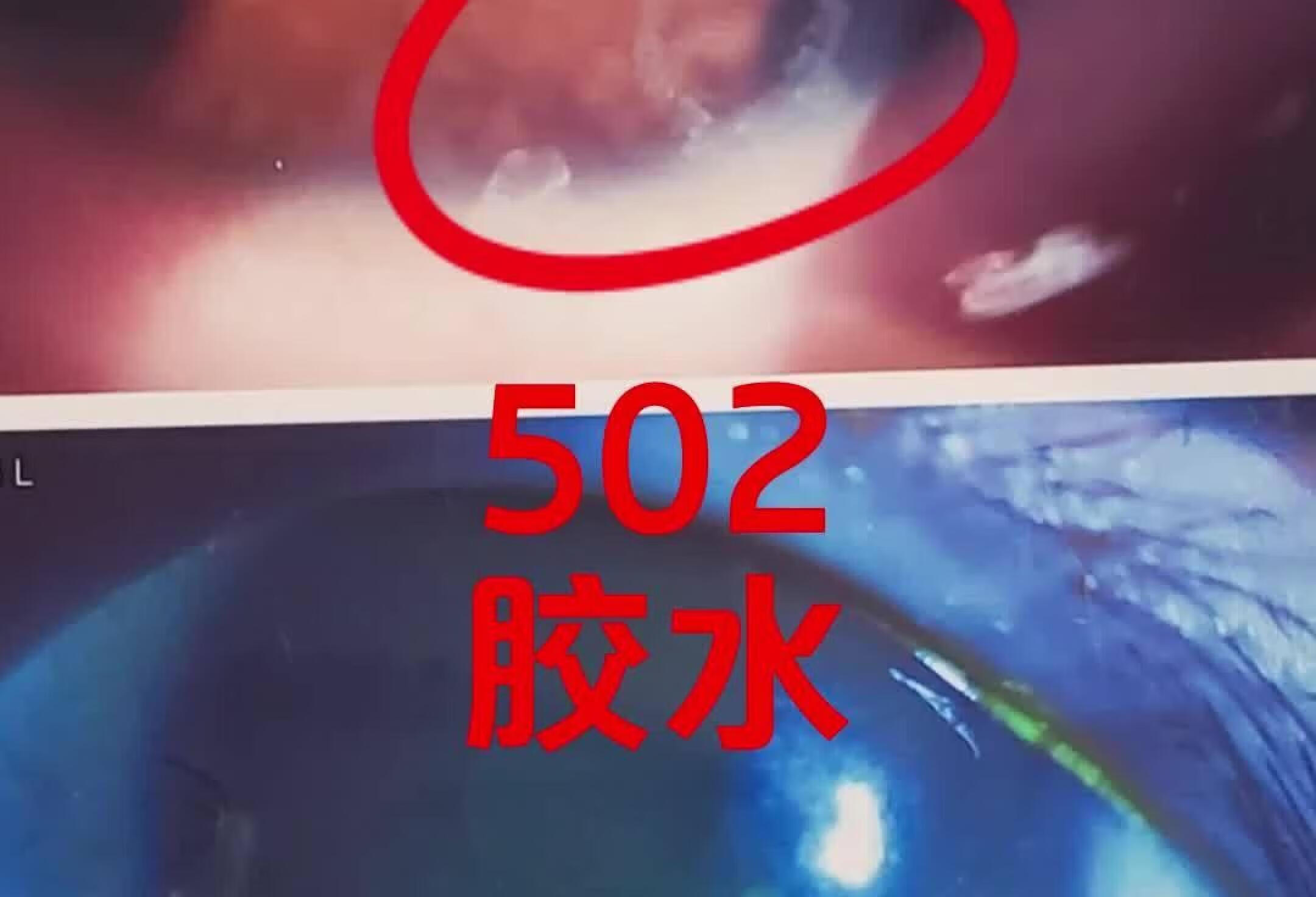 502胶水进了眼睛？！门诊患者实例！