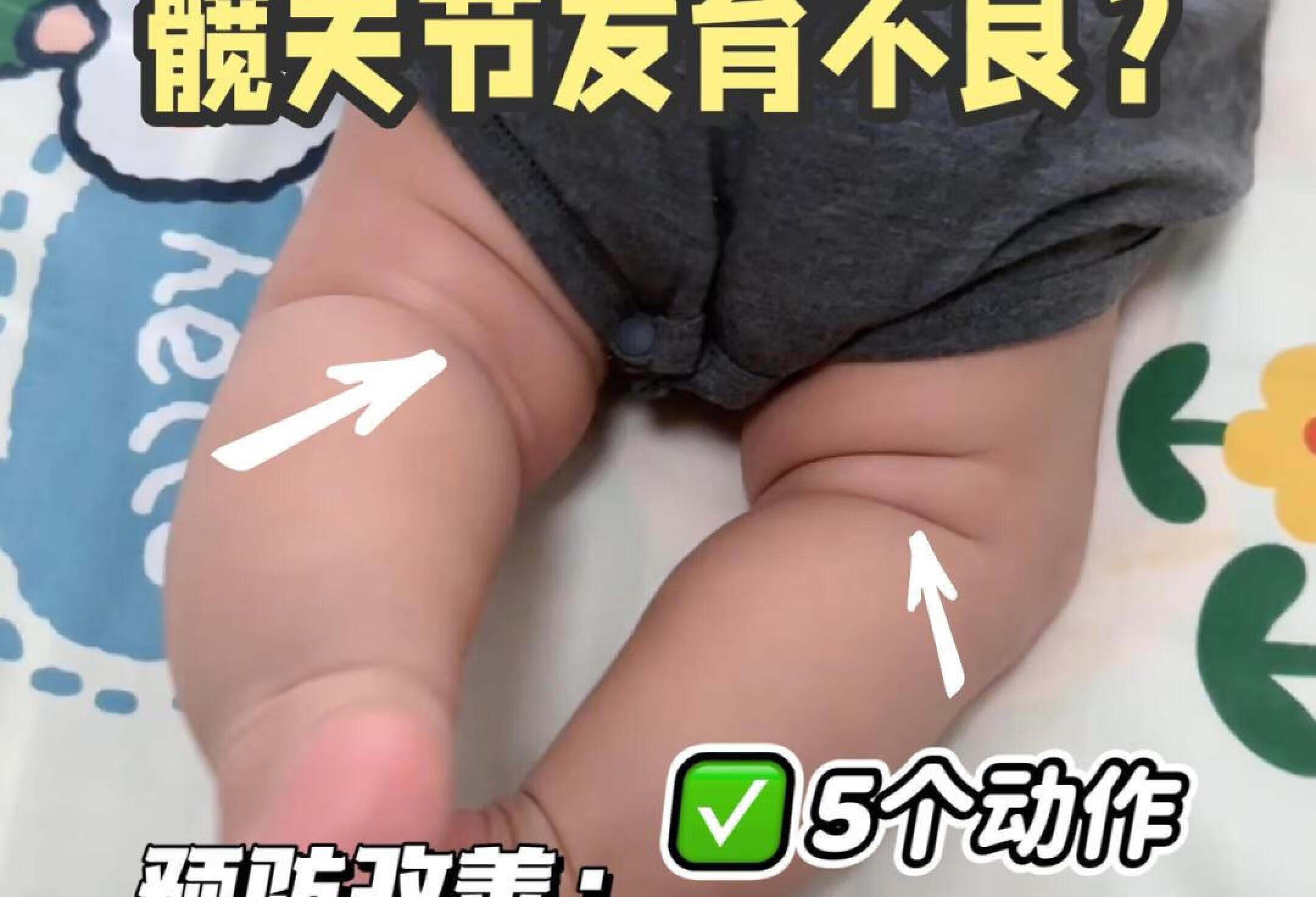 👣腿纹不对称？警惕髋关节发育不良！宝妈必看