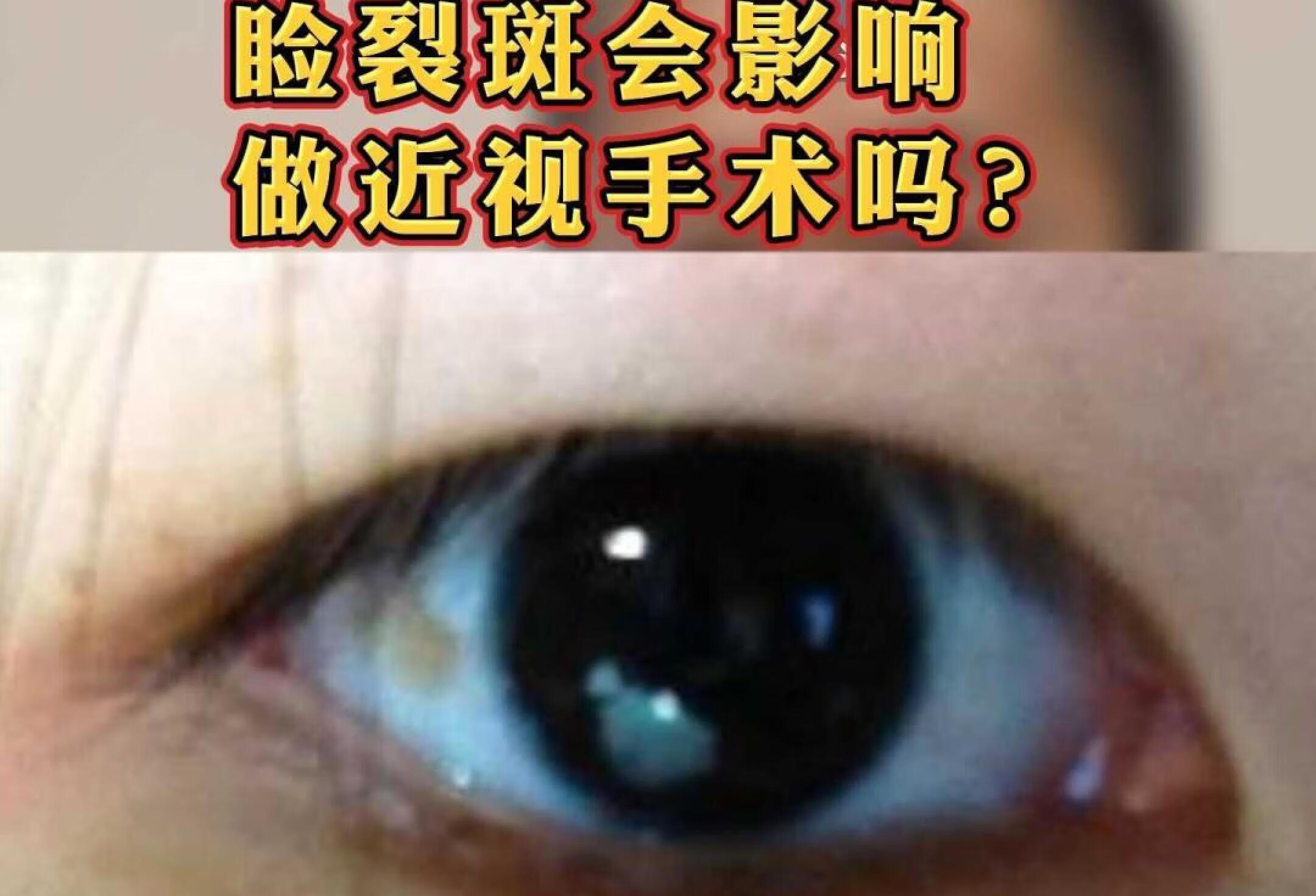 睑裂斑会影响做近视手术吗？