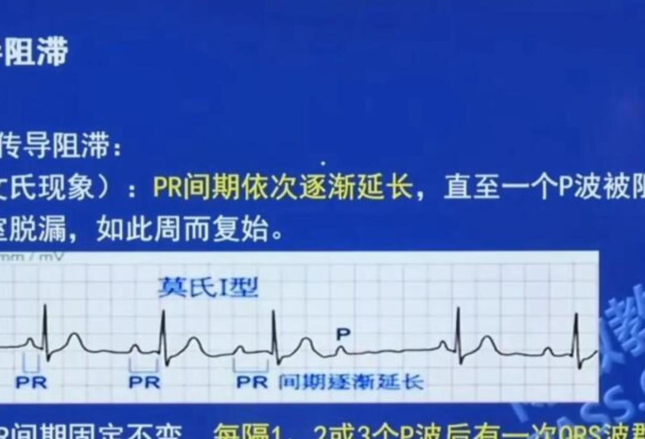 二度房室传导阻滞