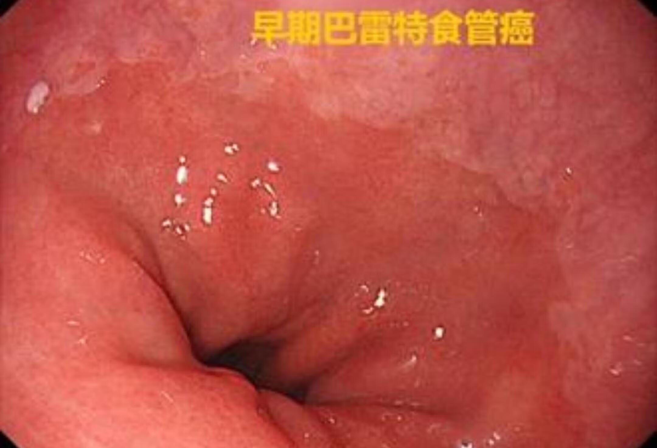 反流性食管炎竟是癌症前兆？