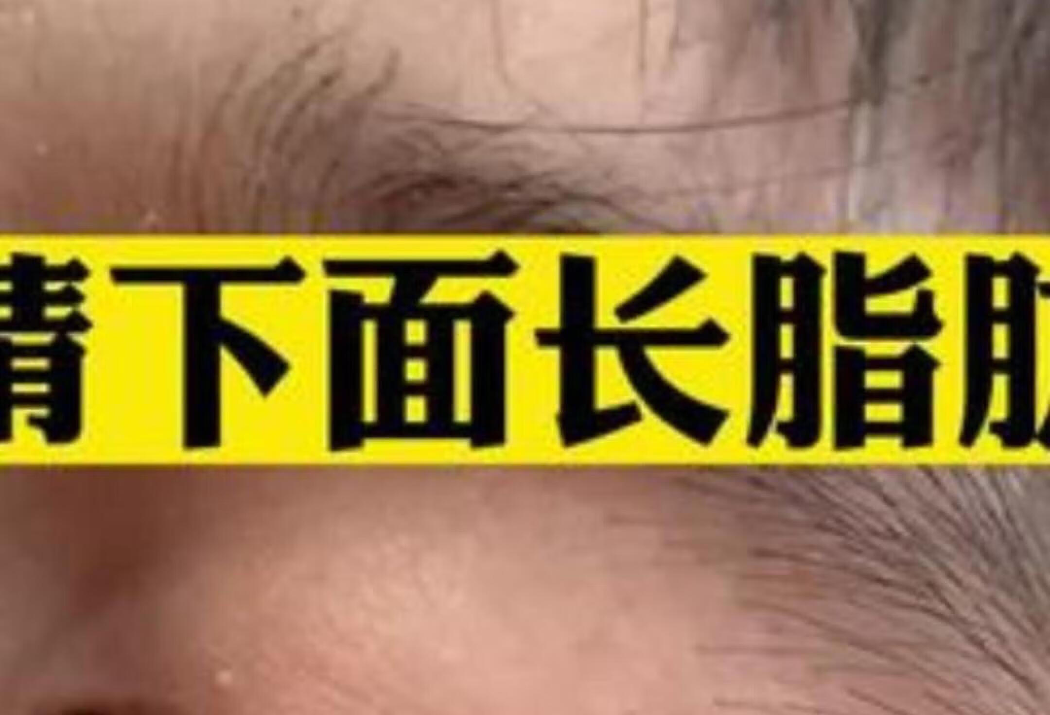 眼下白色米粒？揭密粟丘疹要点