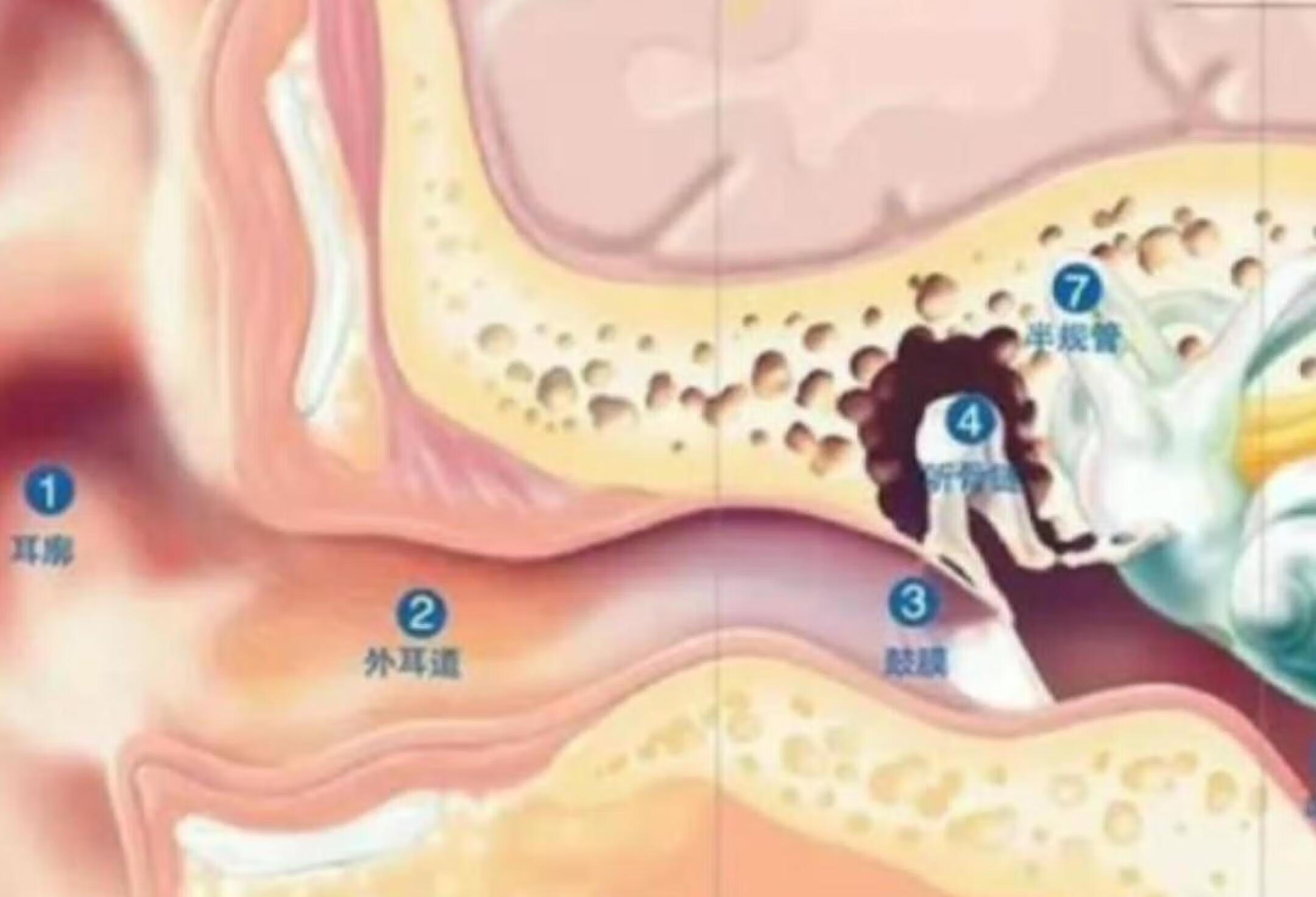 鼓膜是怎么穿孔的？