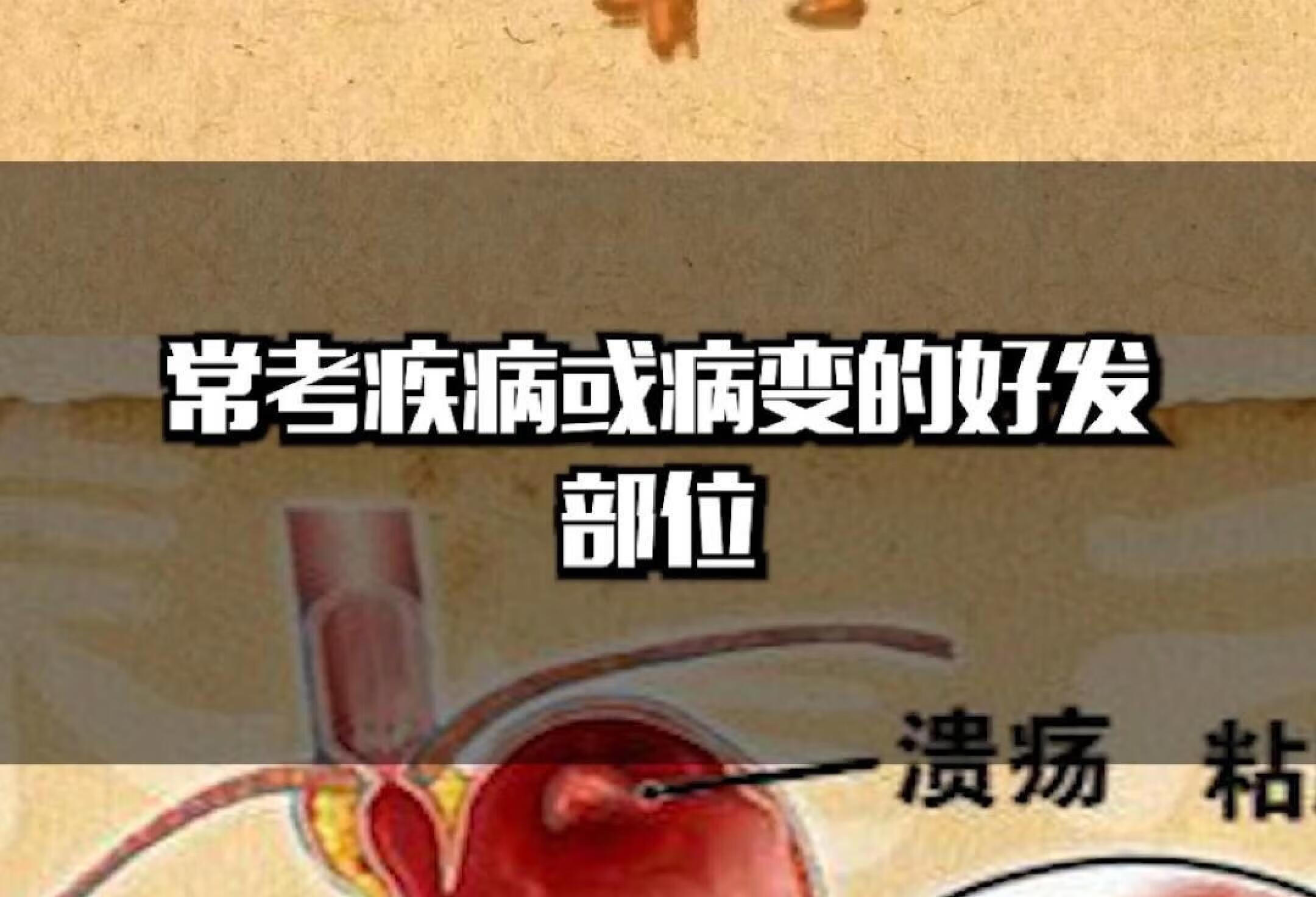 急性胃十二指肠溃疡穿孔