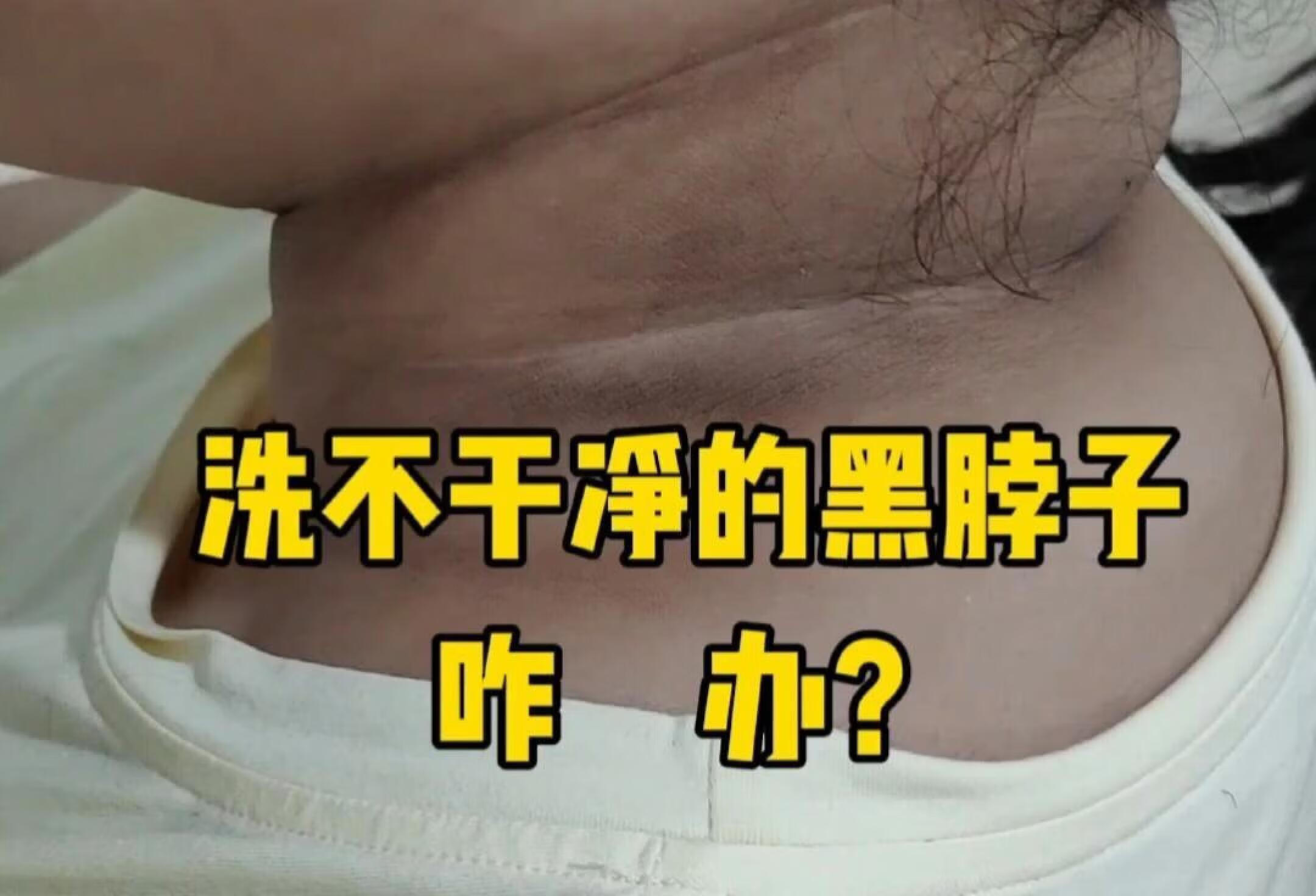 黑棘皮病