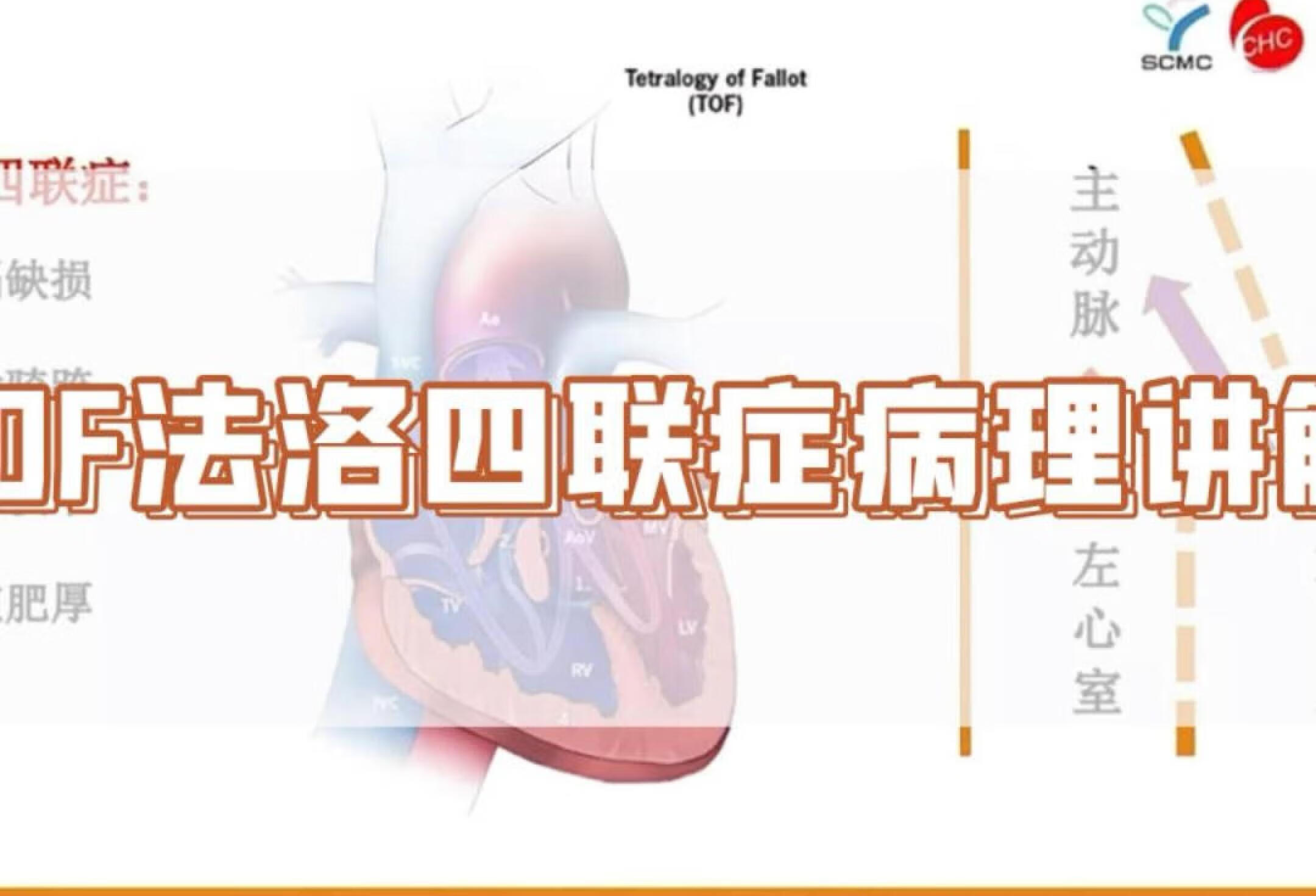 法洛四联症1: 病理生理讲解