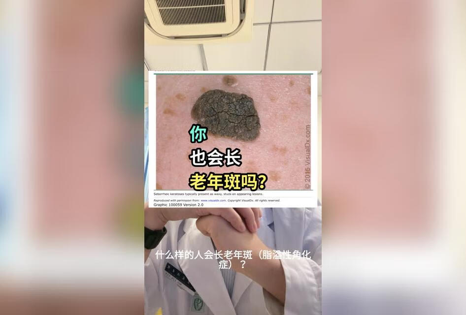 我竟然也长了老年斑呀，郁闷