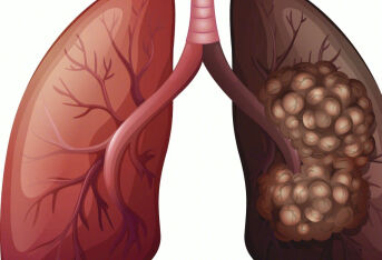  糖链蛋白升高拍CT发现了肺磨玻璃结节
