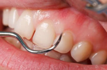 牙龈肿包可以自己拿针挑破吗？
