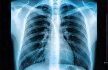 医院哪些检查有辐射——X光