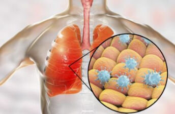 慢性支气管炎的病因有哪些？