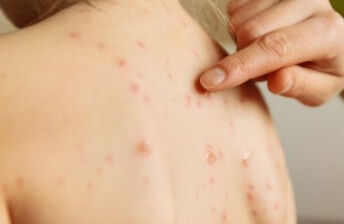 怎么知道自己得了慢性荨麻疹？