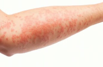 湿疹不怕“湿”，可以洗澡，可以抹润肤油！