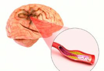 脑出血需要如何预防和保养？