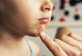 慢性荨麻疹可以吃什么药呢？