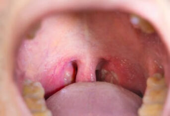 舌扁桃体炎会不会得癌症？