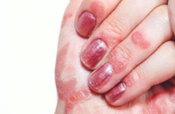哪些皮肤病会传染？