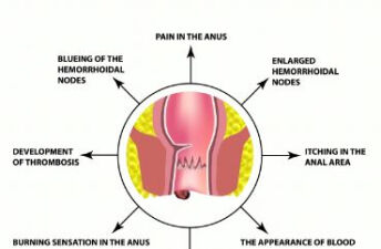肛周脓肿术后换药