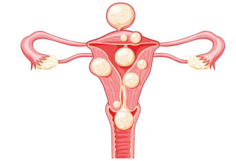 育龄期妇女月经不正常，警惕子宫内膜息肉!
