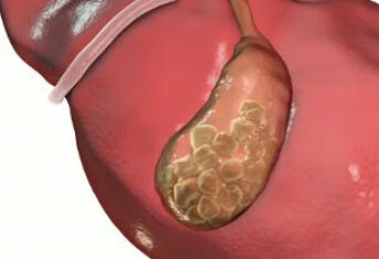 胆结石会引起肾衰竭吗？