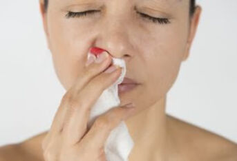 鼻出血你会正确处理吗？