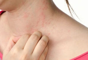 湿疹在身上的表现有哪些？
