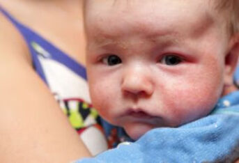 如何治疗婴儿湿疹？