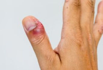 手指甲沟炎怎么治疗呢？