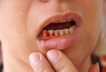 牙龈炎有哪些症状？