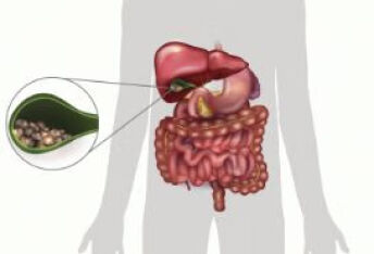 胆囊息肉的治疗方法有哪些？