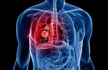 影响肺癌发生的五种气