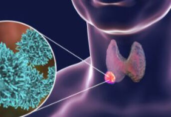 关注甲状腺癌的复发和转移