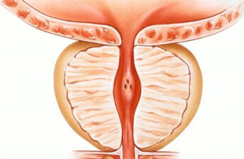 一字之差——前列腺增生与增大有什么区别？