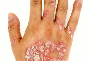 手癣和手部湿疹怎么区分