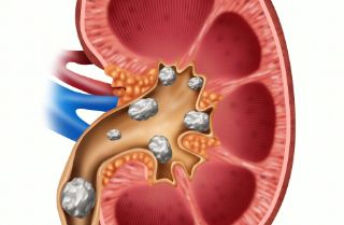 肾结石的发病原理