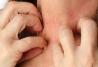 湿疹发病的关键因素