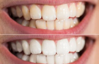 牙龈出血会引起缺铁性贫血吗