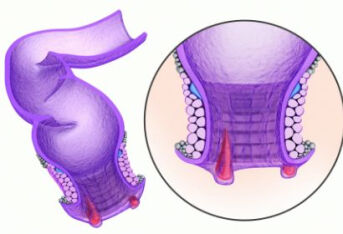 长内痔疮了怎么办？