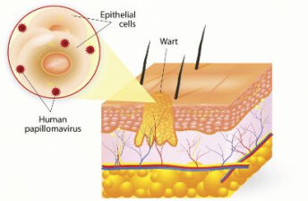 尖锐湿疣：不同治疗方法的适应症