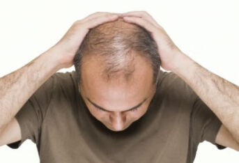 怎么诊断脂溢性脱发