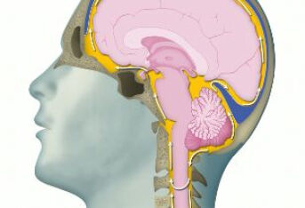 脑脊髓炎治疗有什么方法？