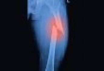 股骨转子间骨折的临床表现及诊断