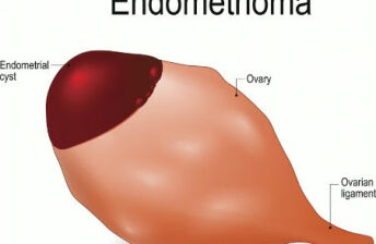 卵巢囊肿病因之环境、饮食和激素