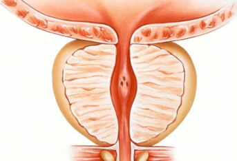 前列腺增生伴钙化是什么意思？