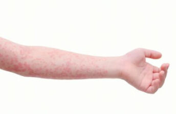 麻疹分期以及症状有哪些？