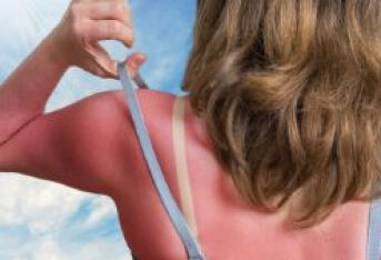夏季皮肤如何防治？